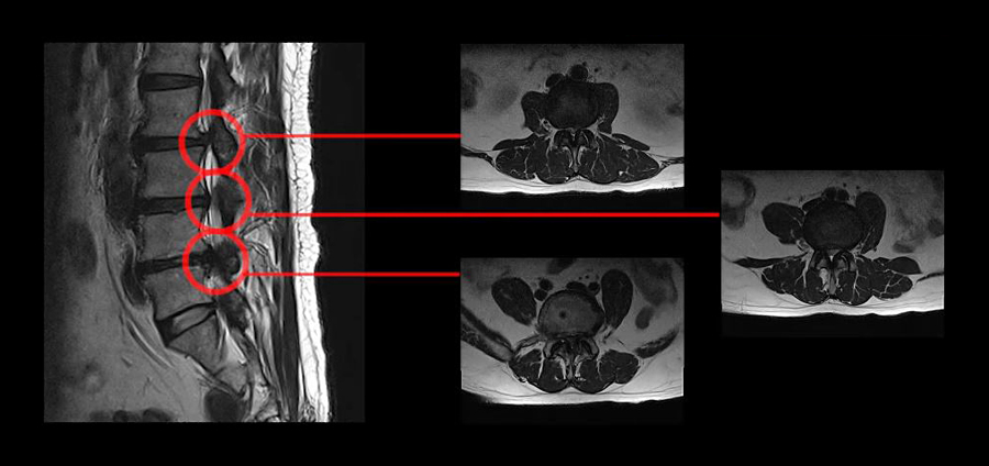 모커리 협착증 근육재활치료를 받은 환자의 MRI