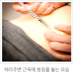 모커리한방병원 허리주변 근육에 봉침을 놓는 모습 이미지